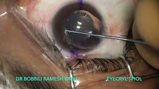 Eyecryl Toric Phakic Intraocular Lens For People Not Suitable For LASER Vision Correction [upl. by Odicalp]