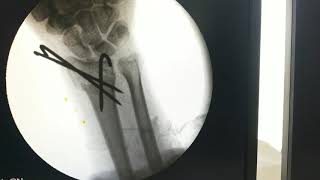 K wire distal radius fracture  Kapandji Technique  Dr Prateek Joshi [upl. by Aric]