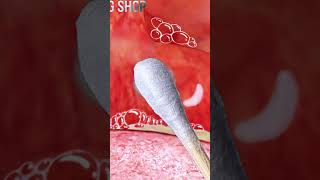 ASMR Zombie oral treatmentoral stones stomatitis tonsillitis treatment animation asmr좀비 압안결석치료 [upl. by Simmons918]