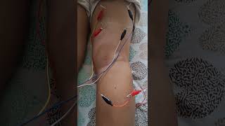 Dry Needle Therapy for leg musclesNeedle Therapy For muscles StimulationDrAnup [upl. by Benge779]