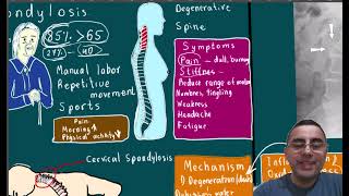 Spondylosis Symptoms causes disease course and treatment [upl. by Kirby730]