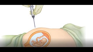 Amniocentesis and CVS Animation [upl. by Aihsal]