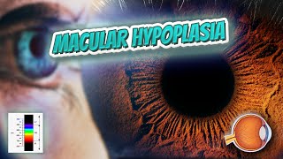 Macular hypoplasia  Your EYEBALLS  EYNTK 👁️👁️💉😳💊🔊💯✅ [upl. by Steinberg4]