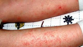 Can You Use Mupirocin Ointment For Eczema [upl. by Sirronal]