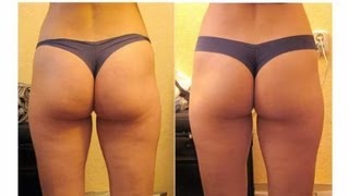 Cellulite Treatments Tested  Cellulite Factor Review [upl. by Josefa]