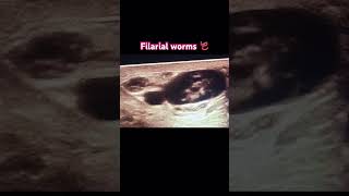 Filarial worms radiology ultrasonography medicine clinical [upl. by Bil]