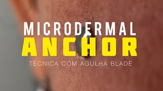 MICRODERMAL ANCHOR COM AGULHA AMERICANA [upl. by Henricks]