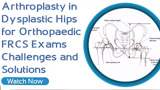 Arthroplasty in Dysplastic Hips for Orthopaedic FRCS Exams  Challenges and Solutions [upl. by Rheingold]