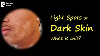 LIGHT SPOTS amp PATCHES ON BROWN OR DARK SKIN Causes amp Treatment  DrNischal K  Doctors Circle [upl. by Ymmor394]