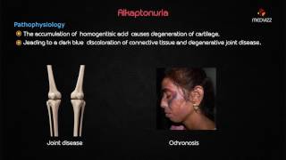 Ochronosis or Alkaptonuria  Usmle step 1 lecture [upl. by Itsym879]