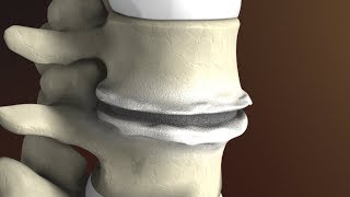 Degenerative Disc Disease Spondylosis explained by Spine Surgeon Dr Jessica Shellock Plano TX [upl. by Reffineg]