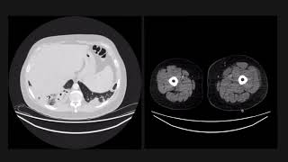 Cavitating lung lesions are a classic exam case [upl. by Papotto472]