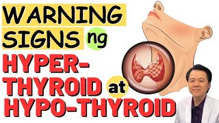 Warning Signs ng Hyperthyroid at Hypothyroid  by Doc Willie Ong internist and Cardiologist [upl. by Arahahs]