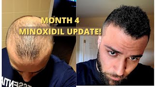 Month 4 ROGAINE RESULTS Minoxidil  Safflower oil [upl. by Dreda]