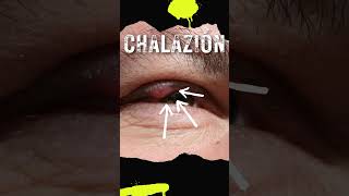 The Battle of Eye Lumps STYE vs CHALAZION  Effective Treatments [upl. by Eilyw986]