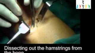 Hamstring graft harvesting by Dr Raju Easwaran [upl. by Nicolea]