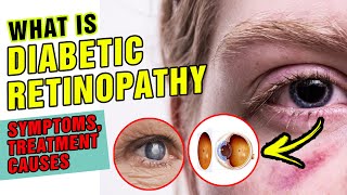 Diabetic Retinopathy Symptoms Treatment and Causes Explained What is Diabetic Retinopathy [upl. by Eiramanna]