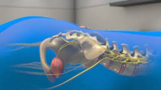 Neuspera Sacral Neuromodulation System for Urinary Urgency Incontinence UUI  3D animation [upl. by Benedikta638]