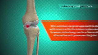 Osteotomy Animation i [upl. by Montanez]