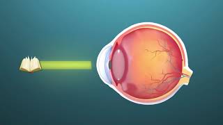 Presbyopia ophthalmology  Animation [upl. by Cordie]