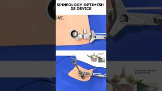 Spineology Optimesh DS Device 3d animation short  Learn Biology with Aliya [upl. by Julio]