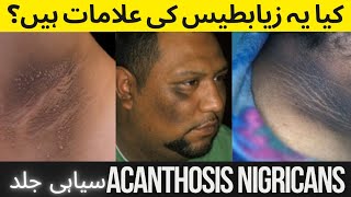 Acanthosis Nigricans Causes  Symptoms Treatment [upl. by Weide]