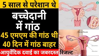 bachedani me gathan ka ilaj  bachedani problem in hindi  fibroid uterus  ayurvedic medicine [upl. by Ycnaffit223]