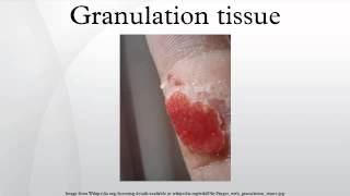 Granulation tissue [upl. by Pollack435]