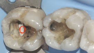 Caries Removal and indirect pulp capping [upl. by Ettenahc342]