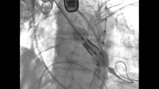 TAVRTranscatheter Aortic Valve Replacement Transaortic Deployment [upl. by Hadria]