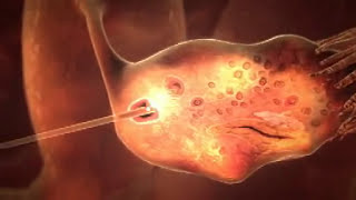 IVF  In Vitro Fertilisation 3D [upl. by Goddard581]