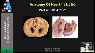 hypoplastic left heart ultrasound video and fetal echo [upl. by Aylmar]