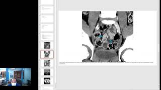 Primary Mesenteric Adenitis Imaging [upl. by Rohpotsirhc]