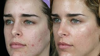 ELIMINA EL ACNE CON AZUFRE – RESULTADOS INCREIBLES [upl. by Simara]