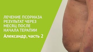 Лечение псориаза Результат через месяц после начала терапии [upl. by Ilke]