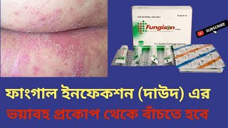 Fungison Cream দাউদ ফাংগাল ইনফেকশন দুর করার উপায়  বাংলা রিভিউ [upl. by Anelaf389]