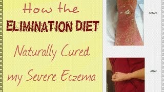 How the Elimination Diet Naturally Cured My Severe Eczema [upl. by Jarrell]