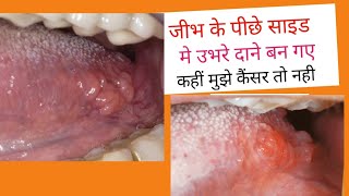 जीभ के पीछे दाने कैसे ठीक करें Bump on side of tongue swollen bumps on side of tongueHow to cure [upl. by Suivatnom751]