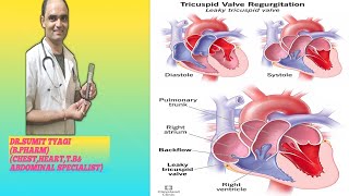 TRICUSPUD REGRATATION DISEASE BY DRSUMIT TYAGISUMITMEDICALDISPENSARY1 [upl. by Malynda]