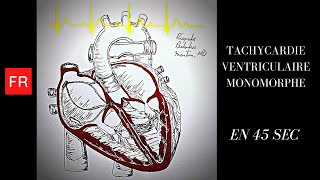 Arythmies animation cardiaque et ECG  Tachycardie Ventriculaire Monomorphe Shorts [upl. by Hilar]