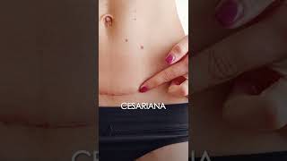 Como fica a cicatriz da abdominoplastia abdominoplastia plasticadeabdome cirurgiaplastica [upl. by Yenrab]