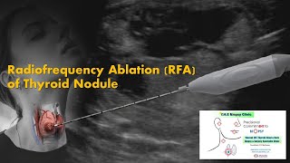 Radiofrequency RFA Thyroid Nodule  Vincent ENT Thyroid HNS clinic [upl. by Nicolas]