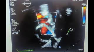 Based on this image what is the sonographer evaluating sp ASD [upl. by Goldston]