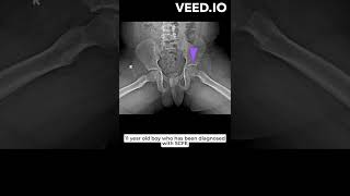 Drehmanns sign positive in a case of SCFE  slipped capital femoral epiphysis [upl. by Hnil557]