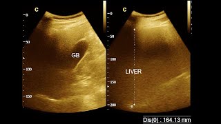 Hepatomegaly  Mild hepatomegaly with fatty change  Ultrasonography report  Amader Hospital [upl. by Kessia]