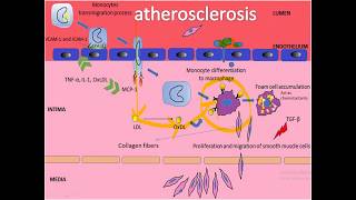 Arteriosclerosis types  Atherosclerosis  PathogenesisStages and Complications [upl. by Austreng308]