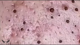 Blackhead Whitehead Removal  Cystic Acne Treatment  Facial Pimple Popping  Elderly Acne Spa 084 [upl. by Monto]