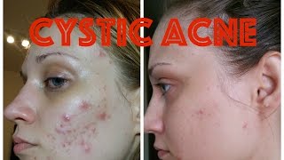 Cystic Acne  How I got rid of it [upl. by Heida500]