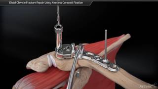 Distal Clavicle Fracture Repair Using Coracoid Fixation [upl. by Catharina]