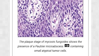 mycosis fungosis [upl. by Sherourd]